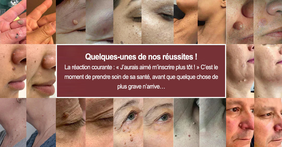 ☀️Patch 2-en-1 Purelora® : Microneedle & Hydrocolloïde🍀 | Élimine les grains de beauté en relief, les verrues planes et les acrochordons | Aide à atténuer les rides, les cicatrices et les imperfections | Patch invisible adapté au visage et au corps