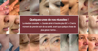 ✨Patch 2-en-1 Purelora® : Microneedle & Hydrocolloïde🍀 | Élimine les grains de beauté en relief, les verrues planes et les acrochordons | Aide à atténuer les rides, les cicatrices et les imperfections | Patch invisible adapté au visage et au corps