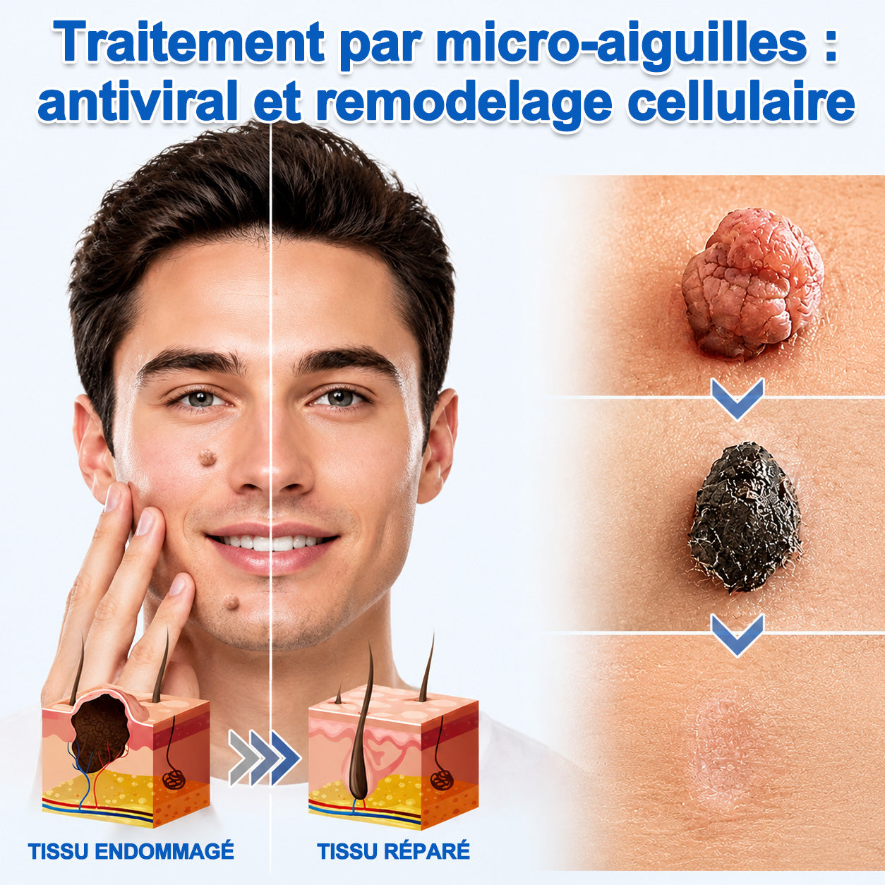 ✨Patch 2-en-1 Purelora® : Microneedle & Hydrocolloïde🍀 | Élimine les grains de beauté en relief, les verrues planes et les acrochordons | Aide à atténuer les rides, les cicatrices et les imperfections | Patch invisible adapté au visage et au corps